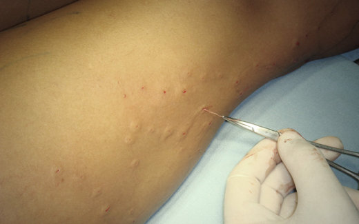 cicatrici dupa operaie varicoza